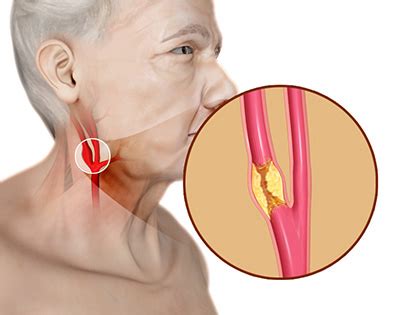 Carotid Artery Disease Treatment Sydney | CAD | Sydney