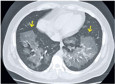 SciELO - Brazil - Differential diagnoses of acute ground-glass opacity in chest computed ...