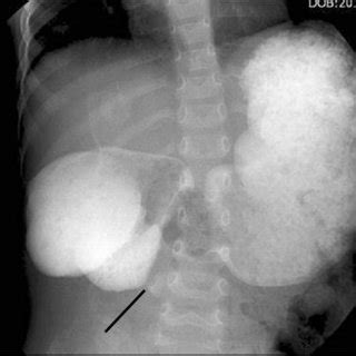 (PDF) Duodenal Obstruction due to Duodenal Web in Three-year-old Girl: A Case Report