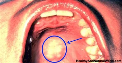 Roof of Mouth Sore: Possible Causes and Home Remedies