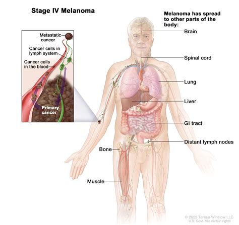 Melanoma Treatment (PDQ®)–Health Professional Version - NCI