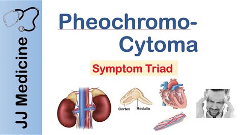 Pheochromocytoma là gì? Triệu chứng, chế độ ăn, phương pháp điều trị