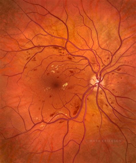 Nonproliferative diabetic retinopathy (NPDR) retina medical illustration