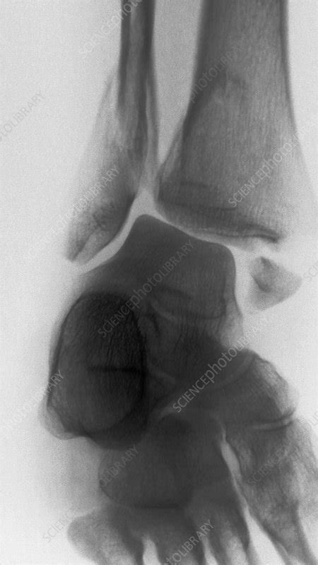 Bimalleolar ankle fracture, X-ray - Stock Image - C002/9951 - Science ...