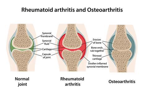 Osteoarthritis Vs. Rheumatoid Arthritis: 3 Differences | Morada Senior Living