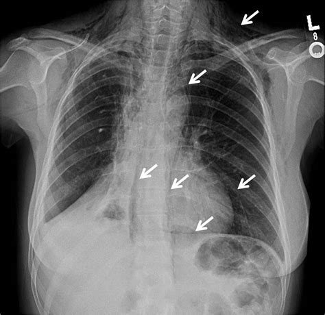 Non-neoplastic Disorders of the Mediastinum: Pneumomediastinum - Pulmonology Advisor