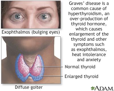 Autoimmune disorders Information | Mount Sinai - New York