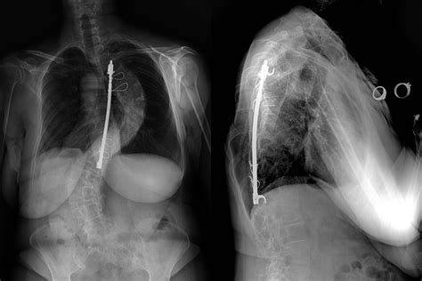 The Evolution of Scoliosis Treatment: A Look at Harrington Rods