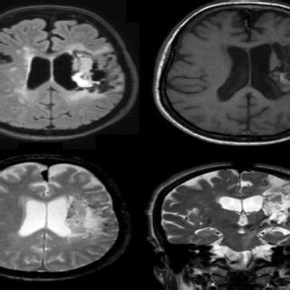 Patient's brain damage evidenced by MRI scan. | Download Scientific Diagram