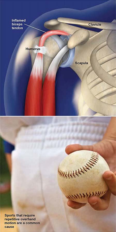 Biceps Tendinitis | Central Coast Orthopedic Medical Group