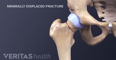 Stress Fracture Symptoms