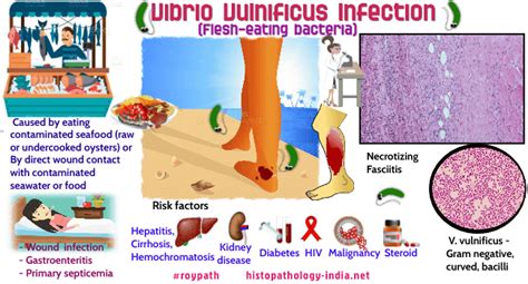 Top Ten Facts About Pathology Of Vibrio Vulnificus - Dr Sampurna Roy MD