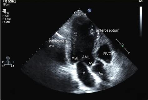 TTE: Transthoracic Echocardiogram - SONOSIF - by SIFSOF, California