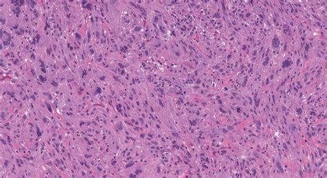 Atypical fibroxanthoma | Atlas of Pathology