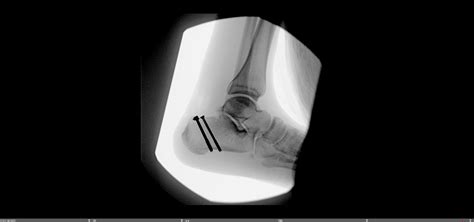 Tongue Type Calcaneus Fracture — Chicago Foot & Ankle Orthopaedic Surgeons