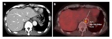 Solitary mediastinal lymph node recurrence after curative resection of ...