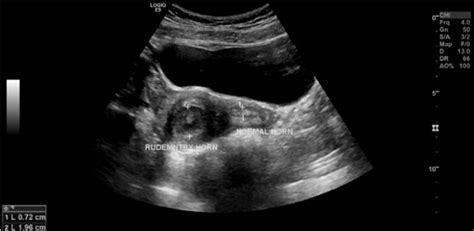 Unicornuate uterus with a functional non-communicating horn in adolescent | BMJ Case Reports