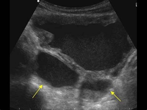 Urinary Tract and male reproductive system | 2.2 Bladder : Case 2.2.3 Miscellaneous bladder and ...