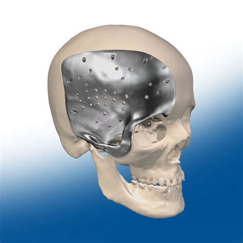 Custom-made cranial implant - Ortho Baltic Implants