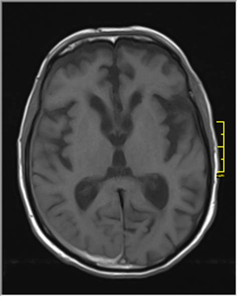 Subdural Hematoma Mri