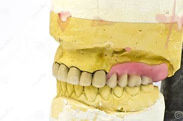 Dental bridge stock image. Image of bridge, artificial - 13957789