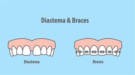 Diastema: Definition, Types,Causes, and Treatment