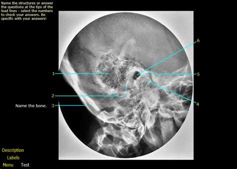 Mastoid X Ray Position