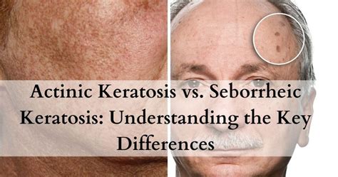 Actinic Keratosis vs Seborrheic Keratosis