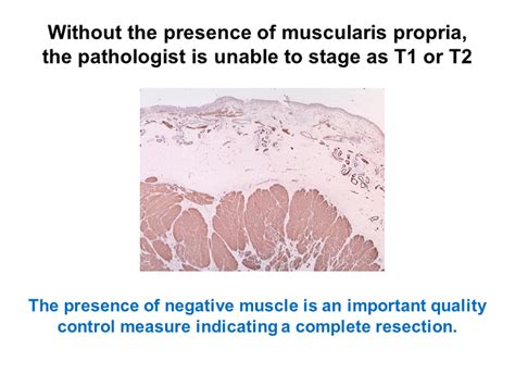 Without the presence of muscularis propria, the pathologist is unable ...