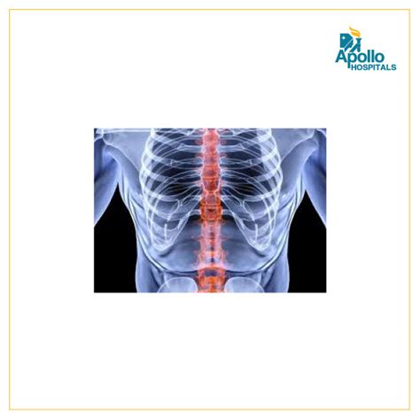 What exactly is Minimal Lower Thoracic Spine Spondylosis? - Apollo ...