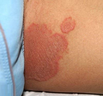 Symptoms causes treatment of disease: Inner Thigh Rash