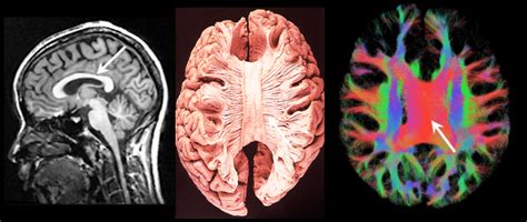 Corpus Callosum Dysgenesis