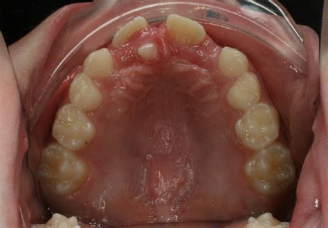 Mesiodens - Supernumerary tooth (hyperdontia) - Bauer Smiles