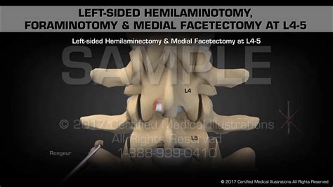 Left-sided Hemilaminotomy, Foraminotomy & Medial Facetectomy at L4-5 - YouTube