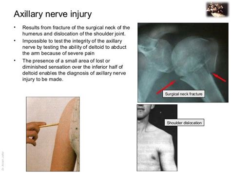 Applied anatomy axillary nerve injury