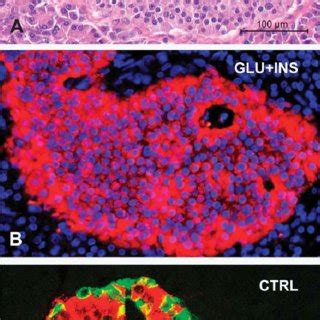 Distribution of tumors, hormone expression, and insulinoma precursor ...