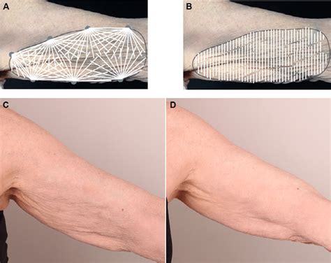 Upper arm injection techniques with diluted calcium hydroxylapatite for... | Download Scientific ...