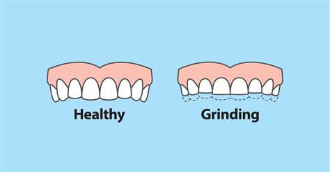 Teeth Grinding Symptoms and Solutions for Kids – ICTeeth Pediatric ...