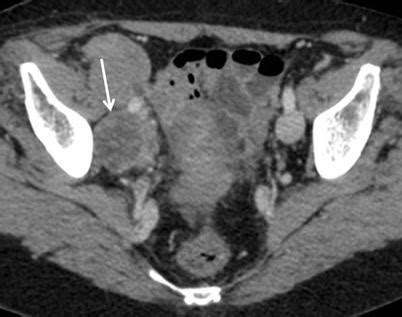 Tumours of the Ovaries: Computed Tomography and Magnetic Resonance | Radiology Key