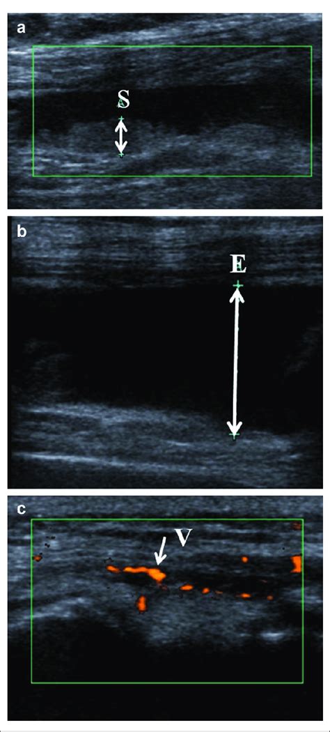 Ultrasound images of the knee of a person with OA: (a) synovial ...