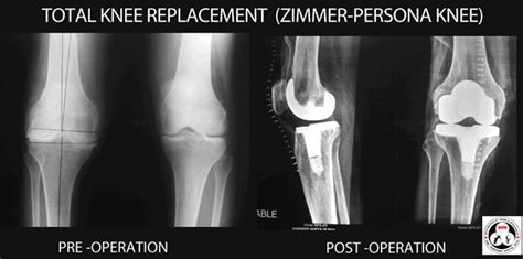 Patient has Knee replacement with persona knee | Sant Parmanand Hospital