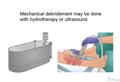 PatEdu.com : Understanding Debridement of Sores