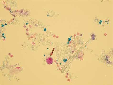 Leukocytes in Urine