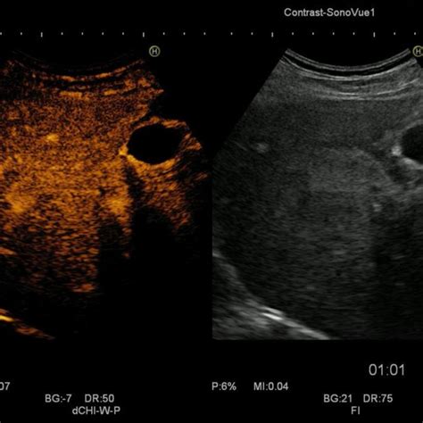 Posterior attenuation of the liver. | Download Scientific Diagram