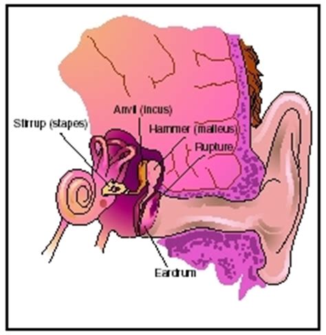 Perforated Eardrum - symptoms, Definition, Description, Demographics, Causes and symptoms ...