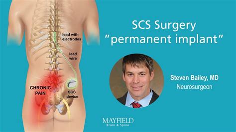 HF10 Spinal Cord Stimulation: Part 2 Surgery - YouTube