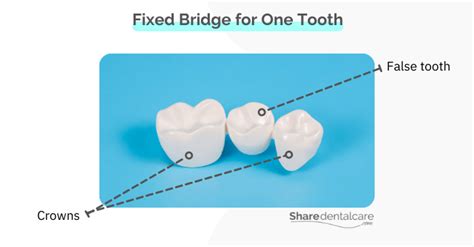 Removable Dental Bridge: Pros & Cons - Share Dental Care