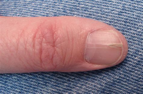 VIRTUAL GRAND ROUNDS IN DERMATOLOGY 2.0: Two Patients with Longitudinal Nail Dystrophy