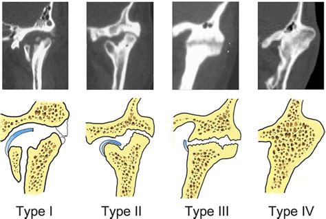 Causes of Tmj ankylosis - MEDizzy