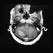 Playlist 'posterior fossa masses' by Dr Sharbell Hashoul